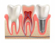 Dental Implants in Dubai