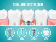 The Best Dentist For Implant Services In South East London