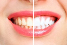 Which Teeth Whitening Service Is Right For You?