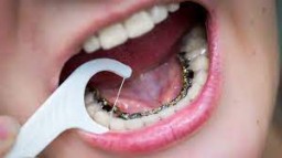 Get Lingual Braces Treatment in Singapore