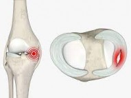 Looking for Knee Arthritis Surgery in Singapore