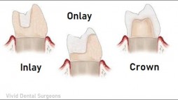 What Should You Know About Veneers Singapore?