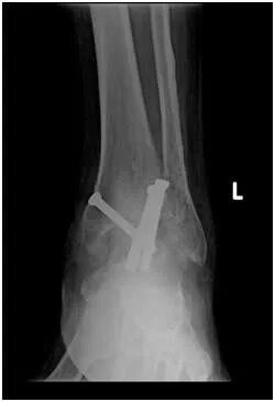 How Long Does It Take To Recover From An Ankle Arthroscopy In Singapore?