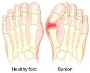 Bunion Treatment Singapore Expert Care for Your Feet