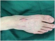 Get details about ganglion surgery in Singapore