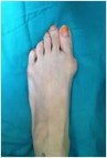 What are the types of foot surgery for bunions?