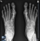 Know about the types of foot surgery for bunions