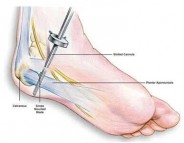 Effective Plantar Fasciitis Treatment in Singapore: Options and Outcomes