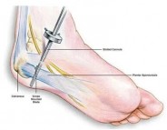 ACL Surgery in Singapore: Advanced Techniques for Knee Ligament Reconstruction