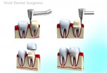 Crowning Glory: Advanced Dental Crowning Services