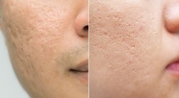 Flawless Reflections: Acne Scar Treatment in Singapore
