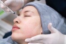 Scar-Free Confidence: Best Acne Scar Treatment in Singapore