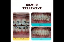 Dental Braces Treatment in Bangalore - Zen Dental Care