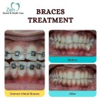 Best Dental Braces Treatment in Bangalore