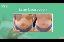 Best Laser Liposuction Treatment in Bangalore
