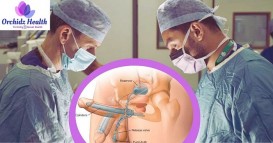 Best penile implant surgery in India - Orchidz Health