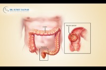 Best Colorectal Surgeon in Bangalore