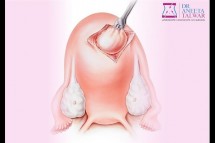 Best Myomectomy Surgery in Whitefield Manipal