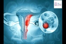 Best Ovarian Cancer Treatment in Whitefield, Manipal
