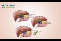 Best Laparoscopic Gall Bladder Surgery in Bangalore