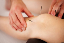 Dry Needling Therapy NYC
