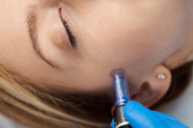 Laser Facial Treatment Daytona Beach