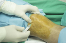Expert Knee Surgeon in Warrington – Personalised Treatment for Knee Conditions