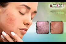 Best Deep Acne Scars Treatment in Bangalore