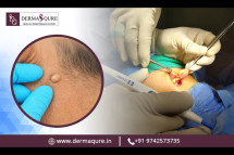 Affordable Sebaceous Cyst Removal Cost in Bangalore