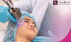 Best CO2 Laser Treatment in Bangalore