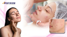 Acne Treatment in Sudama Chowk, Surat