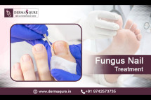 Effective Fungus Nail Treatment in Bangalore