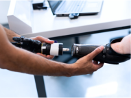 Premium Upper Limb Prosthetics in Dubai | Ortho Innovations