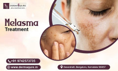 Restore Your Natural Glow with Melasma Treatment in Bangalore – DERMAQURE