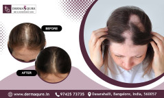 Effective Alopecia Solutions in Bangalore - Dermaqure