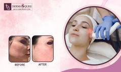 Advanced CO₂ Laser Treatment in Bangalore for Skin Rejuvenation - Dermaqure