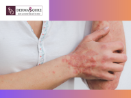 Get Expert Skin Psoriasis Treatment in Bangalore - Dermaqure