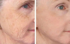 Fractionated CO2 Laser for Acne Scars & Pigmentation in Altamonte Springs, Orlando, Daytona Beach & Clermont