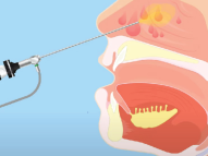 Endoscopic Sinus Surgery in Dubai | Dr Mustafa Kapadia