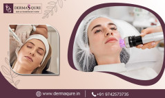 Affordable Cost of Microneedlingin Treatment in Bangalore-Dermaqure