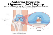 ACL Injury Treatment by Specialist Knee Surgeon | Expert Care Near Manchester