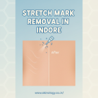Stretch Mark Removal in Indore for Smooth Clear Skin