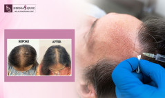 Get Natural Hair Growth with GFC Treatment in Bangalore - Dermaqure