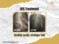 GFC Treatment in Indore for Advanced Hair Restoration