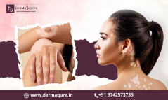 Personalized Advanced Vitiligo Treatment in Bangalore - Dermaqure