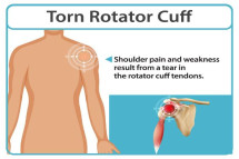 Rotator Cuff Injury Specialist vs General Orthopedist – Learn the Difference