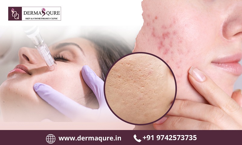 Transform Your Skin With Professional Acne Treatment In Bangalore - Dermaqure Skin And Cosmetology Clinic
