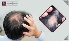 Regain Healthy Hair with Expert Care Through Alopecia Treatment in Bangalore
