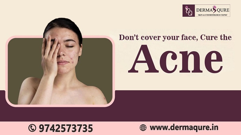 Get Your Clear Skin Through Acne Treatment In Bangalore - Dermaqure Skin And Cosmetology Clinic