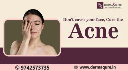 Get Your Clear skin Through Acne Treatment in Bangalore - Dermaqure Skin and Cosmetology Clinic